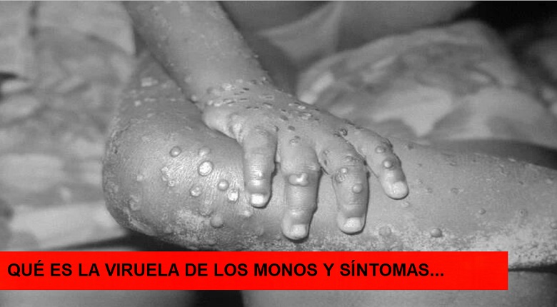 La viruela de los monos y sus síntomas…